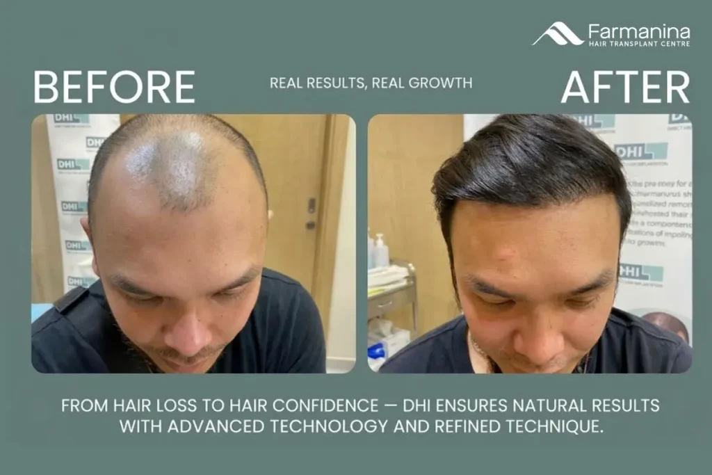 Hasil tanam rambut di Farmanina Clinic.