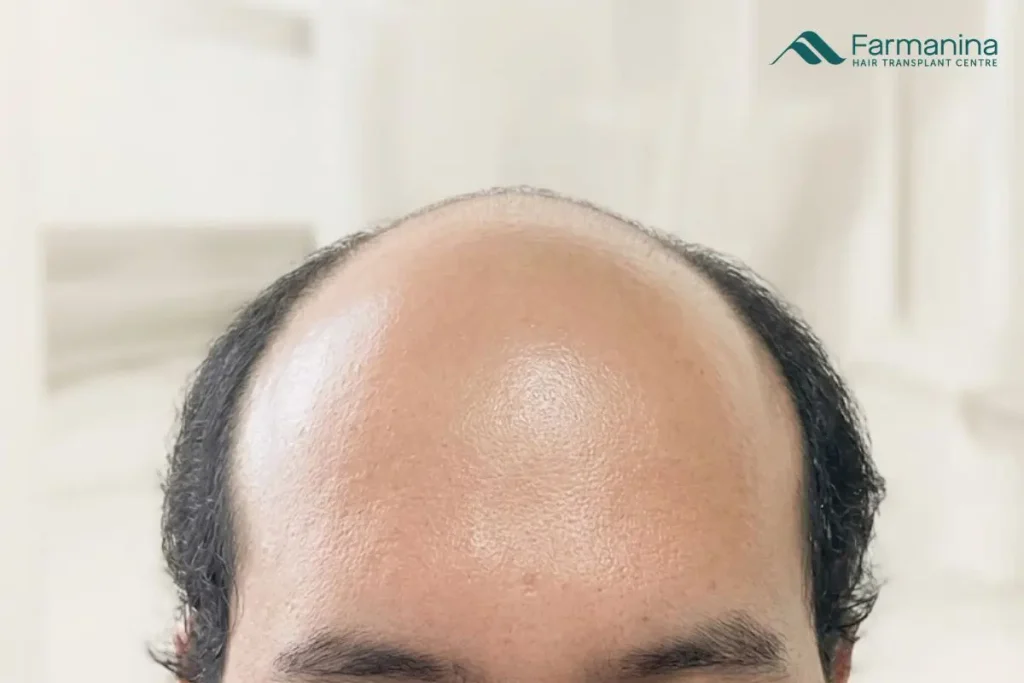 Kebotakan alopecia androgenic