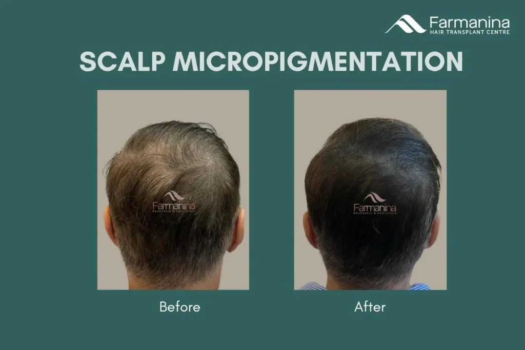 Hasil scalp micropigmentation di Farmanina Clinic