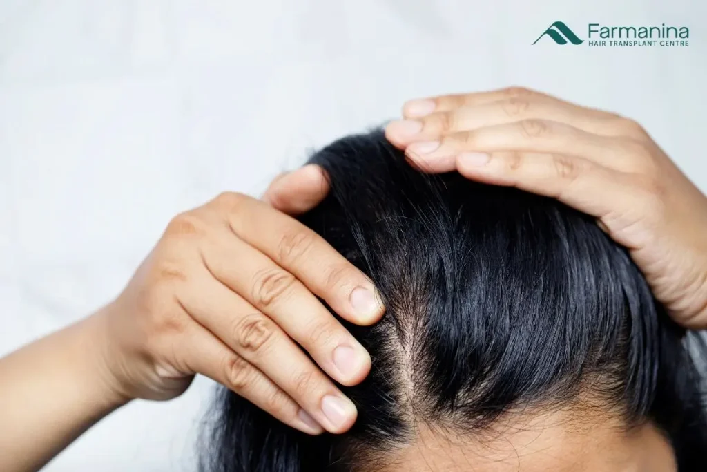 Wanita dengan masalah rambut tipis