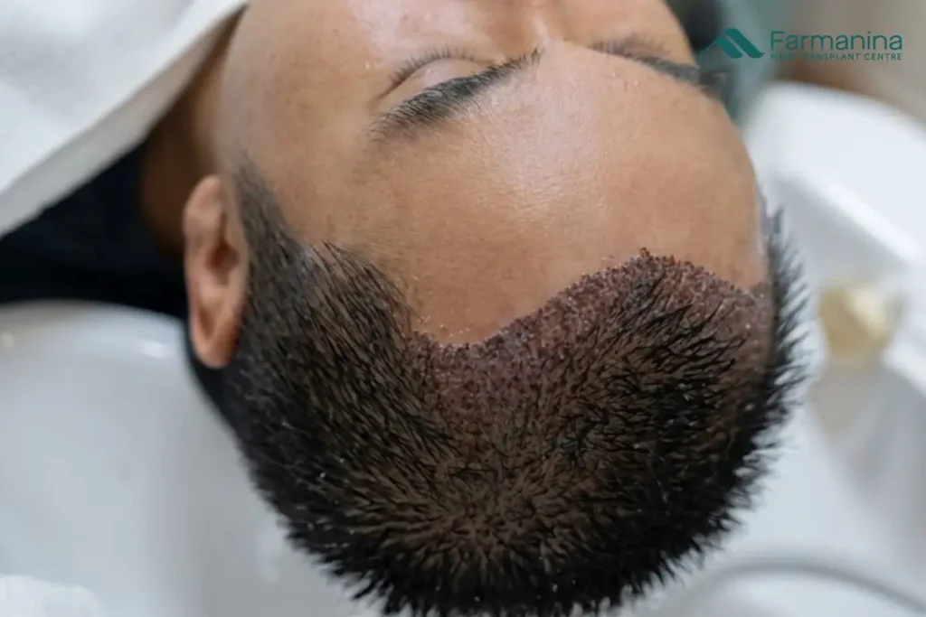 Tanam rambut di Farmanina Clinic