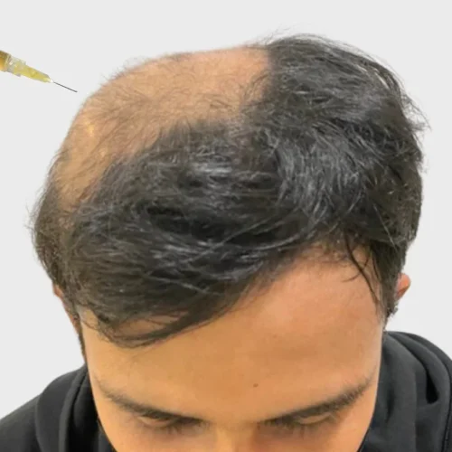 Alopecia Areata Therapy