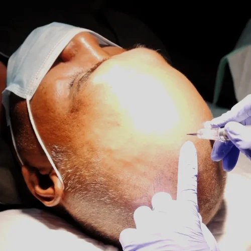 Scalp Micropigmentation (Mpg)